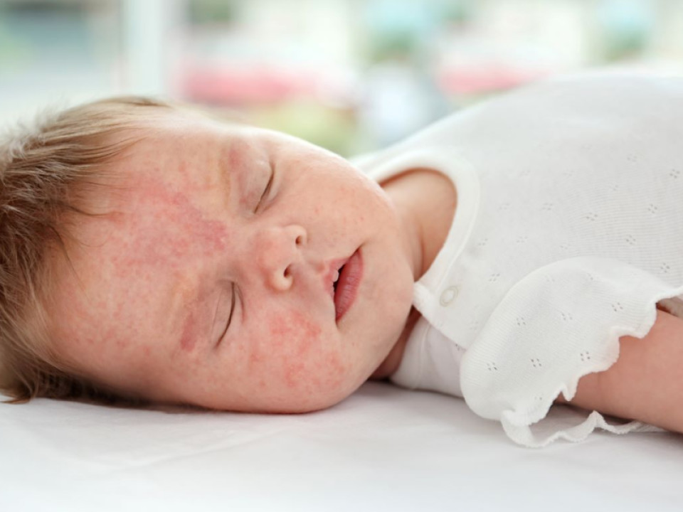 أسباب غير متوقعة لحساسية الطعام عند الأطفال