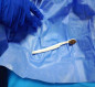 استخراج فرشاة اسنان من معدة شاب عراقي ابتلعها بالخطأ