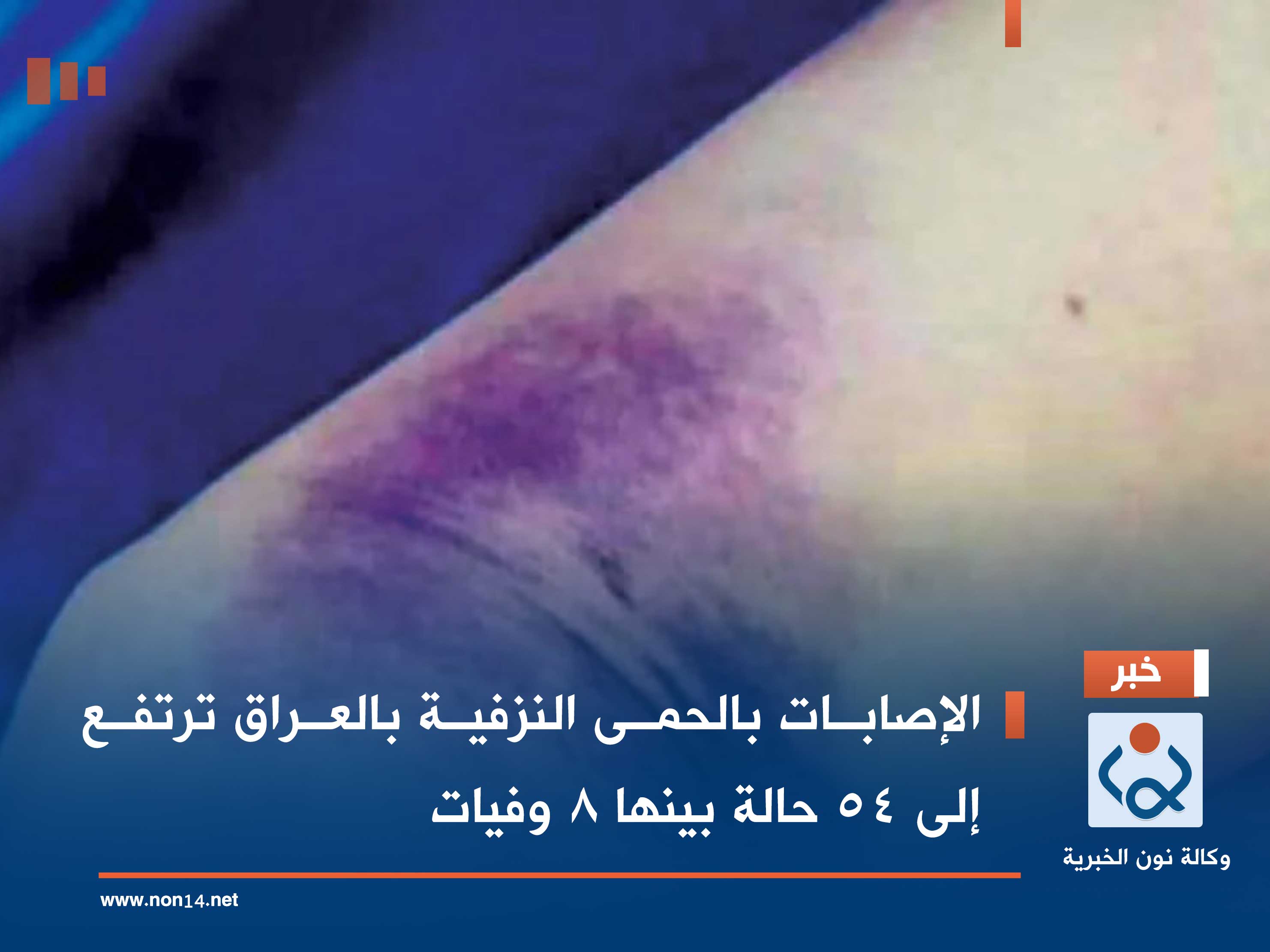 الإصابات بالحمى النزفية بالعراق ترتفع إلى 54 حالة بينها 8 وفيات