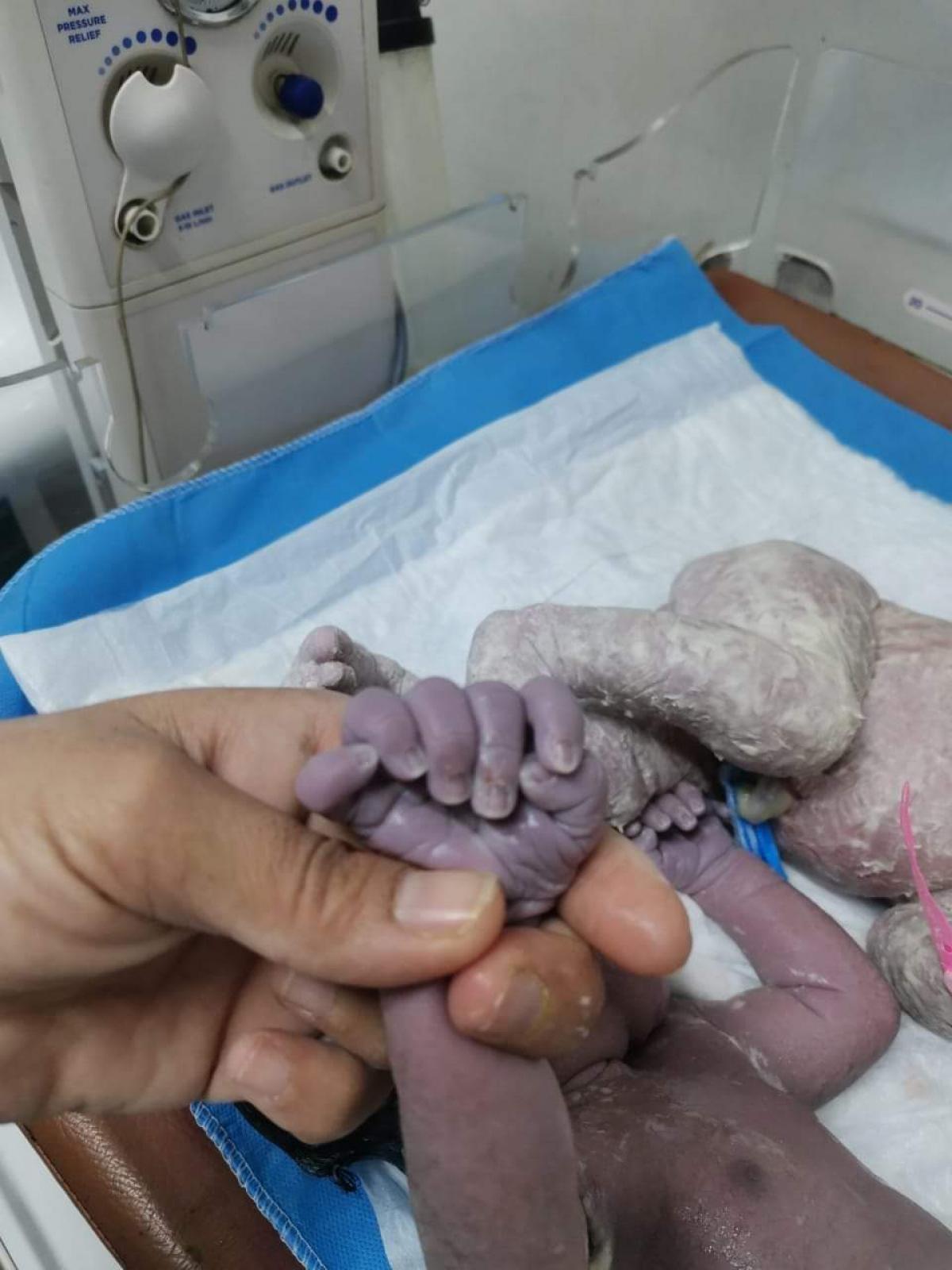 بالصور .. ولادة نادرة لطفلة بـ24 اصبعاً في بغداد