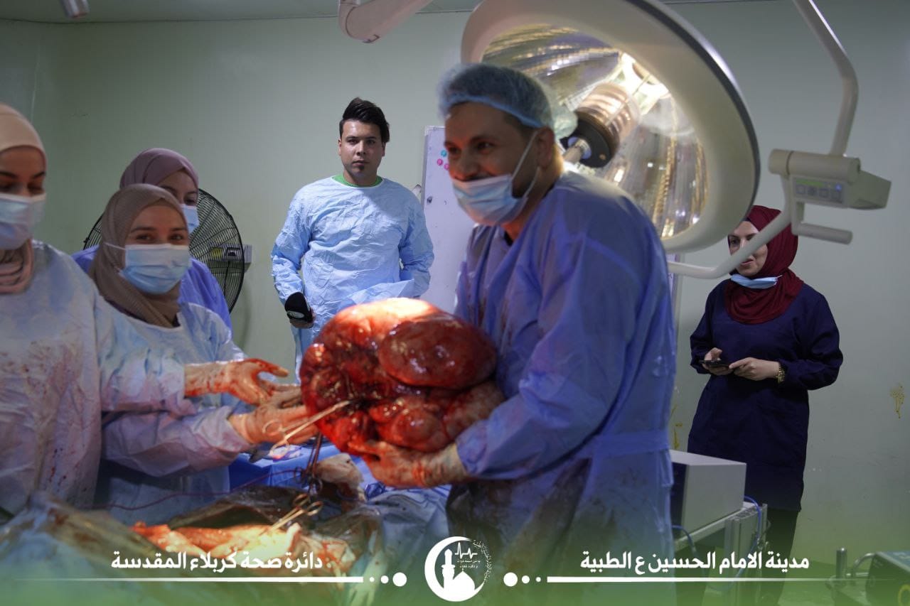 يزن أكثر من ( 25 ) كغم .. في كربلاء وبعمليةٍ نادرةٍ إزالة ورم من بطن إمرأةٍ أربعينية